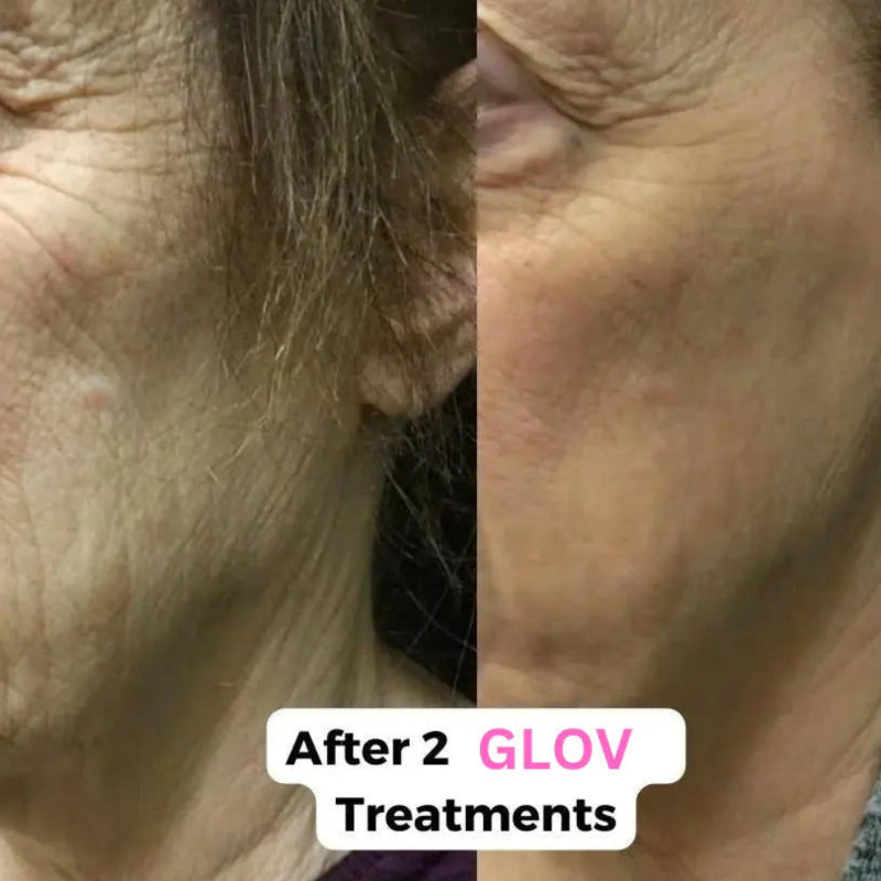 Glov Micro Infusion System