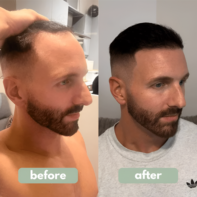 Rosemary Hair Serum Rolling Ball Essence Hair Root Strengthen Serum Scalp Care Essential Massage Roller Ball Nourishing